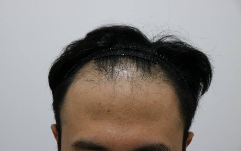 모발이식 과연 가능할까했는데 잘 수술받았습니다.