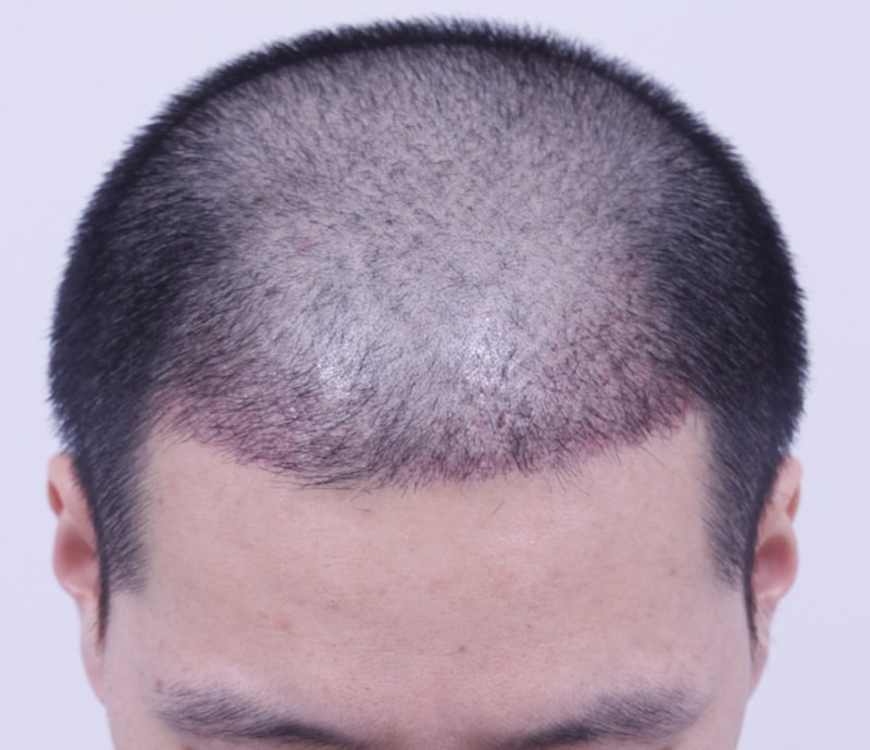 이식후 3주.JPG