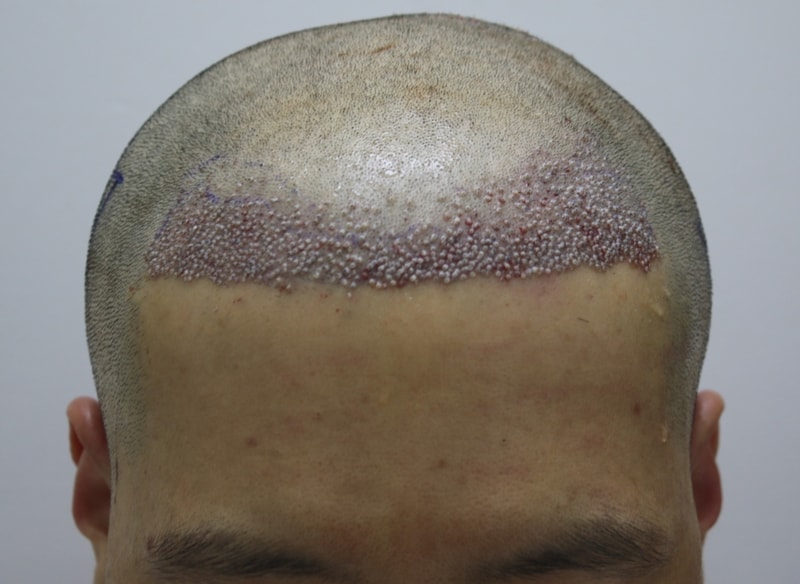 1200모낭 이식후.JPG