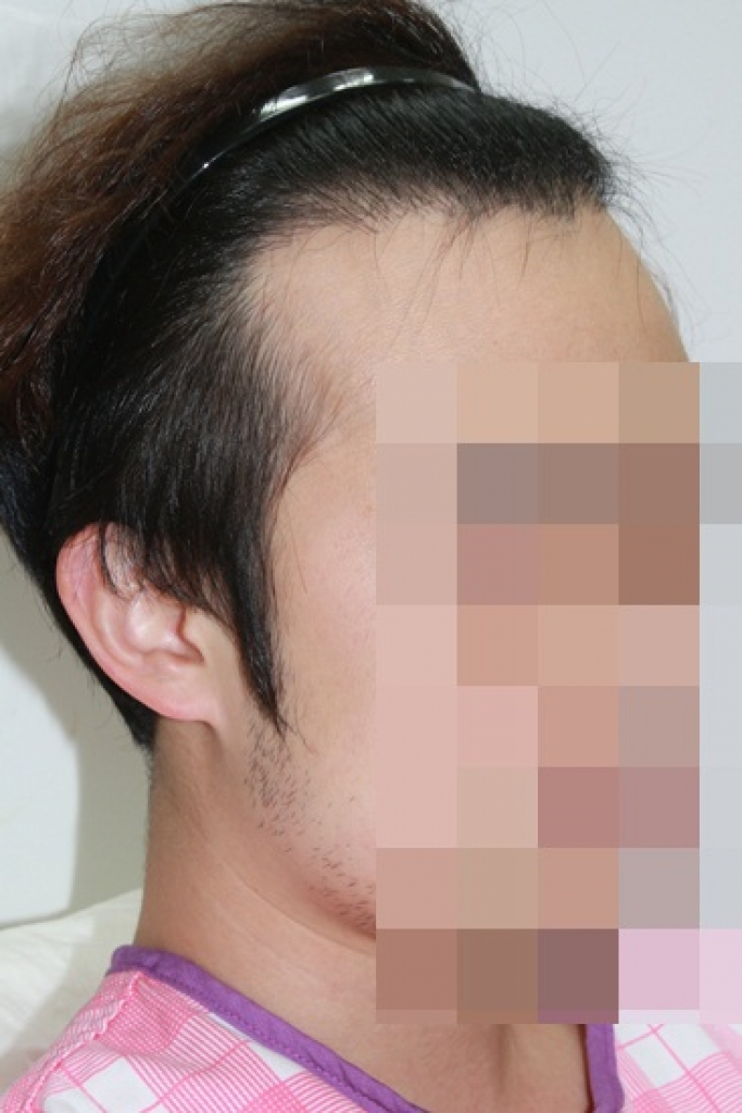 서울 포헤어 비절개 수술한 후기 작성