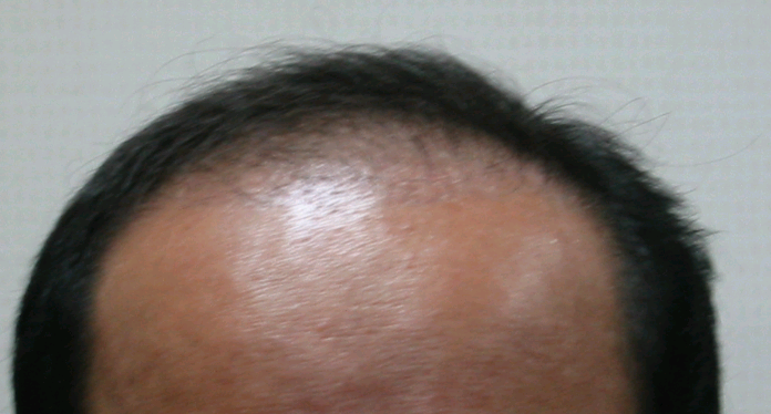 수술후1달.bmp