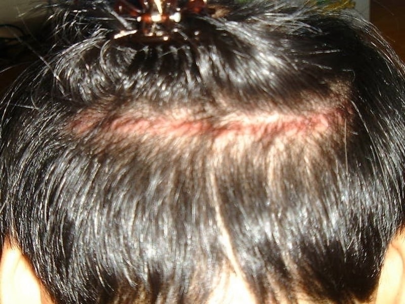 scar.jpg