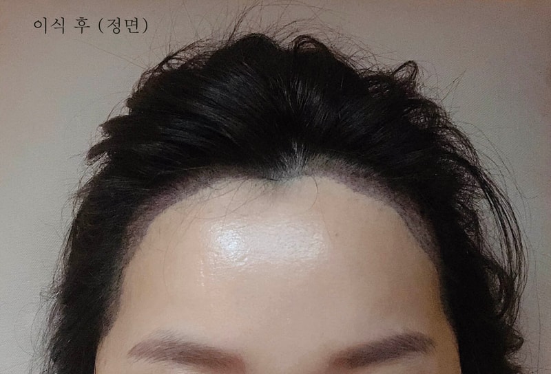 이식후정면.jpg