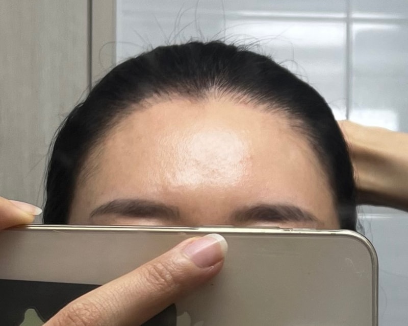 [모두모의원 대구] 모발이식 1년 1개월 경과