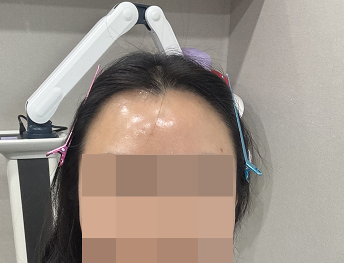 5. 최근 정면사진 앞쪽에 원래 있던  잔머리를 제모할까 말까 고민중이에요 한올한올 소중해서 ㅠㅠ.jpg