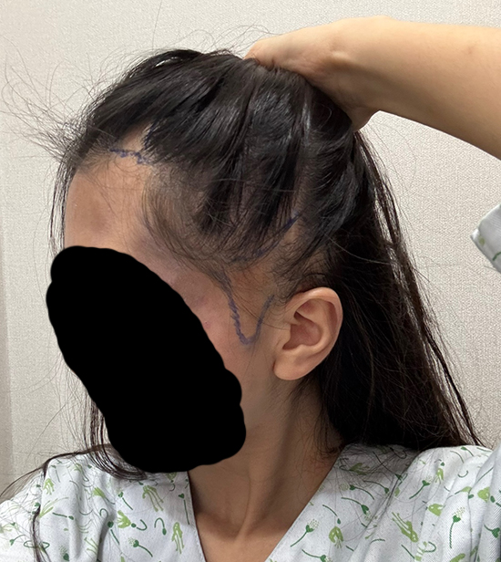 모플러스 성형외과 : 흉터 모발이식 후기! 8개월 16일