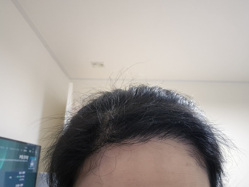 뉴헤어 헤어라인 6개월차