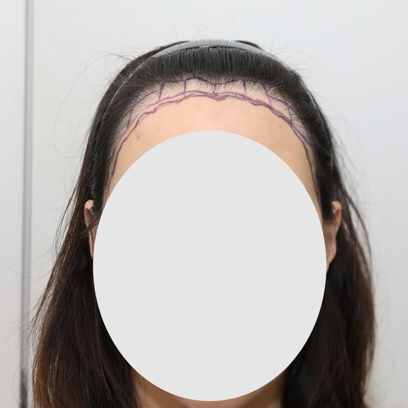 뉴헤어 서울 / 절개 모발이식 재수술 / 1800 모낭 / 1년차 후기입니다