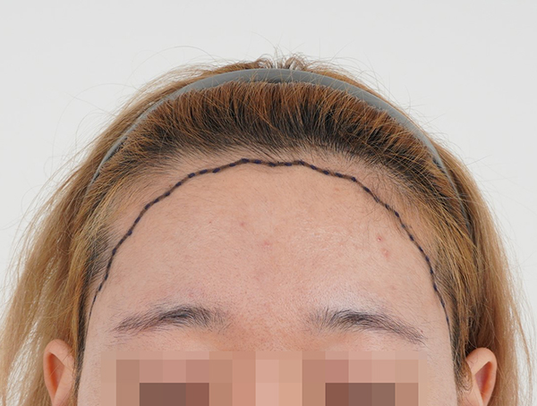 수원여성탈모병원 모모 수원 문효섭원장님께 헤어라인 이식 받은 후기 남겨요