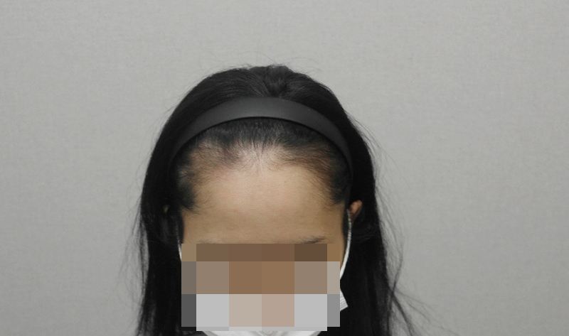 <모플러스 성형외과> 콤플렉스 극복을 위한 헤어라인 모발이식 2700모 3일차 후기!
