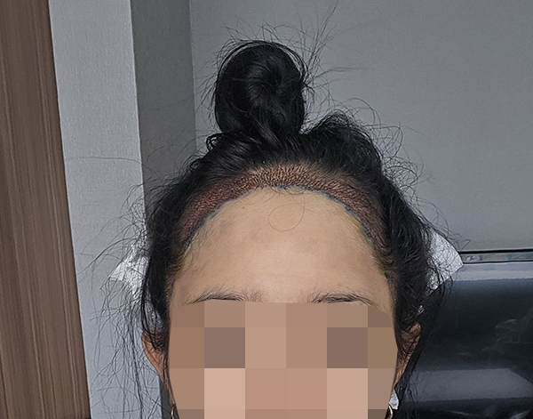 7. 수술 끝나고 옷갈아입고 혼자 찍어봤어요 컴플렉스 부분이 바로 채워지는 게 넘나 신기함.jpg