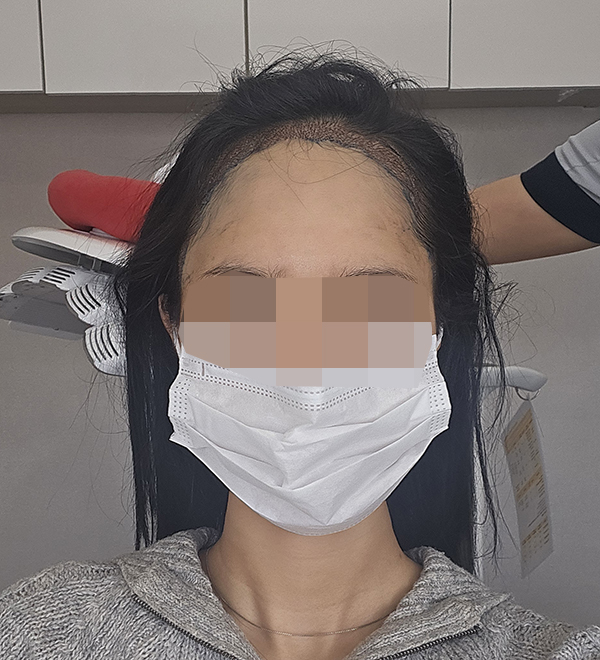 8. 수술받은 다음날 찍은 사진이에요 호텔에서 자고 일찍 방문했어요.jpg