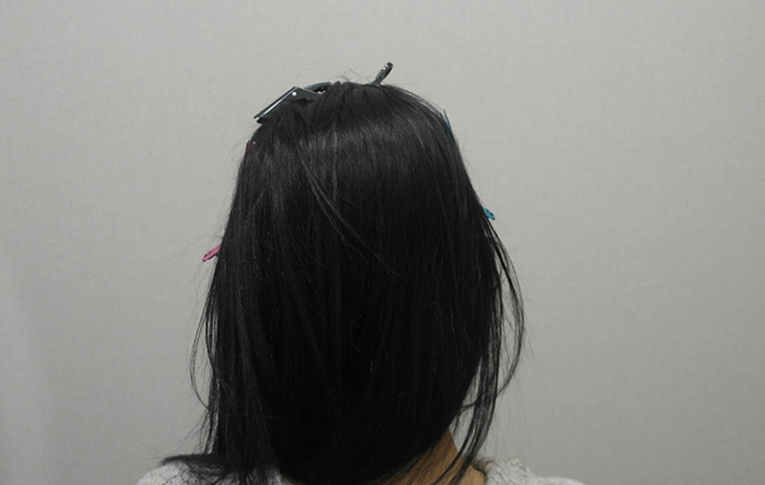 9. 수술다음날 찍은 뒷머리에요 부분삭발 했는데 이렇게 가려져서 티1도 안남 무삭발 900모 섞어해서 더 티 안나는 걸 수도....JPG