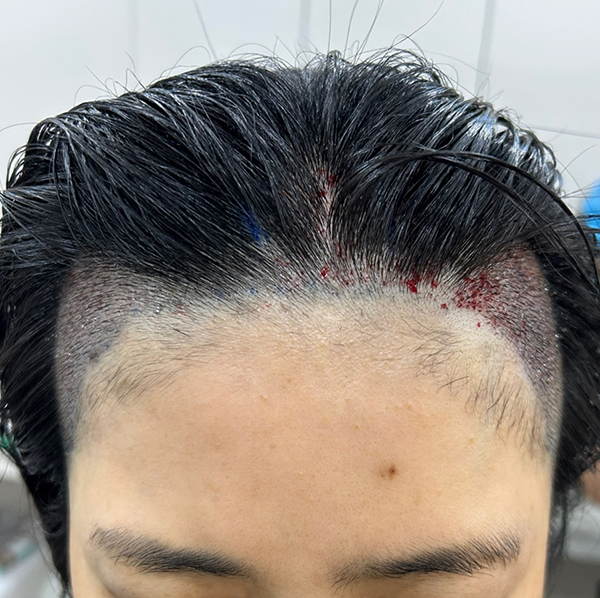 구미모발이식 모모 대구점에서 비절개 2100모 이식 받았어요