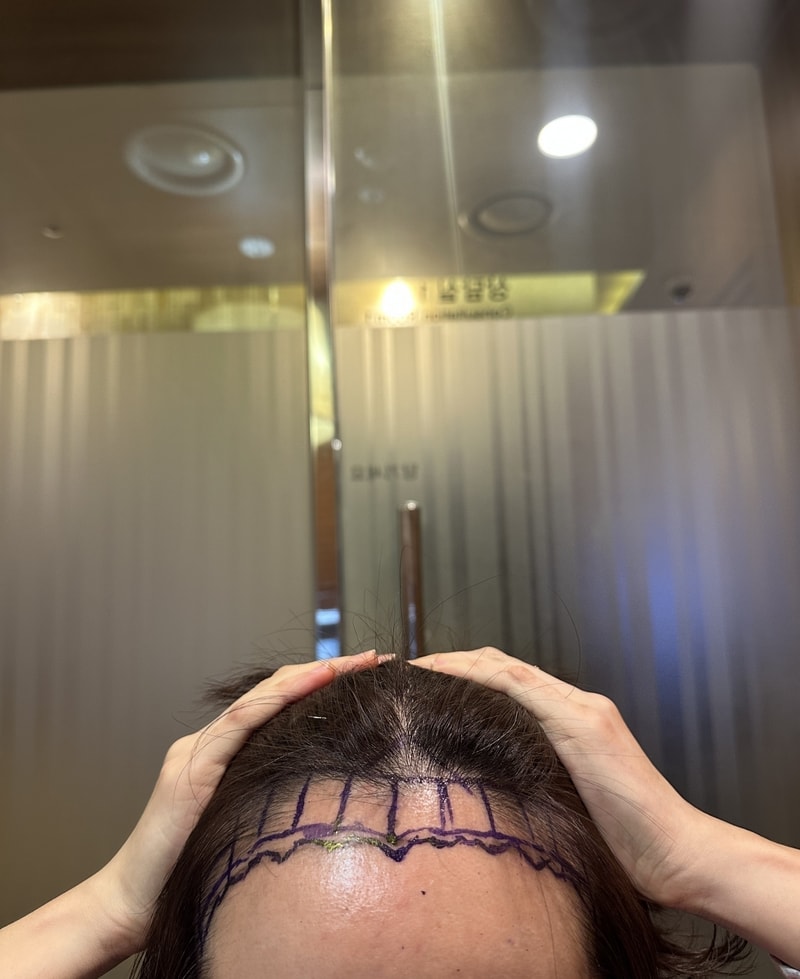 뉴헤어 헤어라인교정 1800 모낭 후기