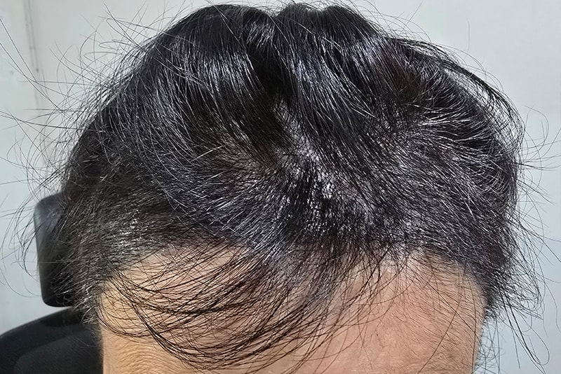 모나라모발이식 (4).jpg