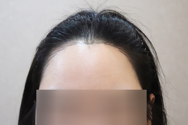 女士发际线切开2500毛8个月了！