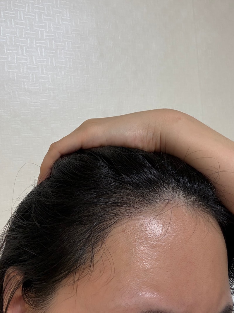 这是从女性毛发移植中心宋英灿院长那里接受1400毛移植的第6个月后期！
