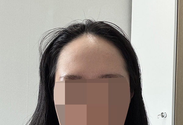 MoPlus Plastic Surgery 毛发移植非切开 2600 毛 手术第二天 热乎乎的后记