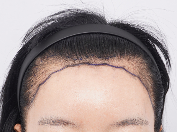 以东滩女性脱发而闻名的毛茂整形外科医院在水原店接受了发际线2000毛手术。