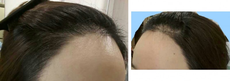 수술후7일째.png
