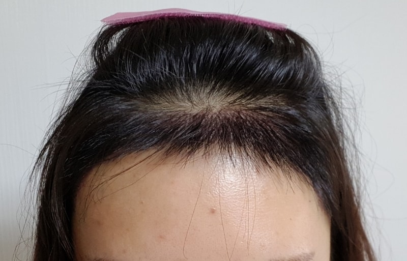 수술 다음날.jpg