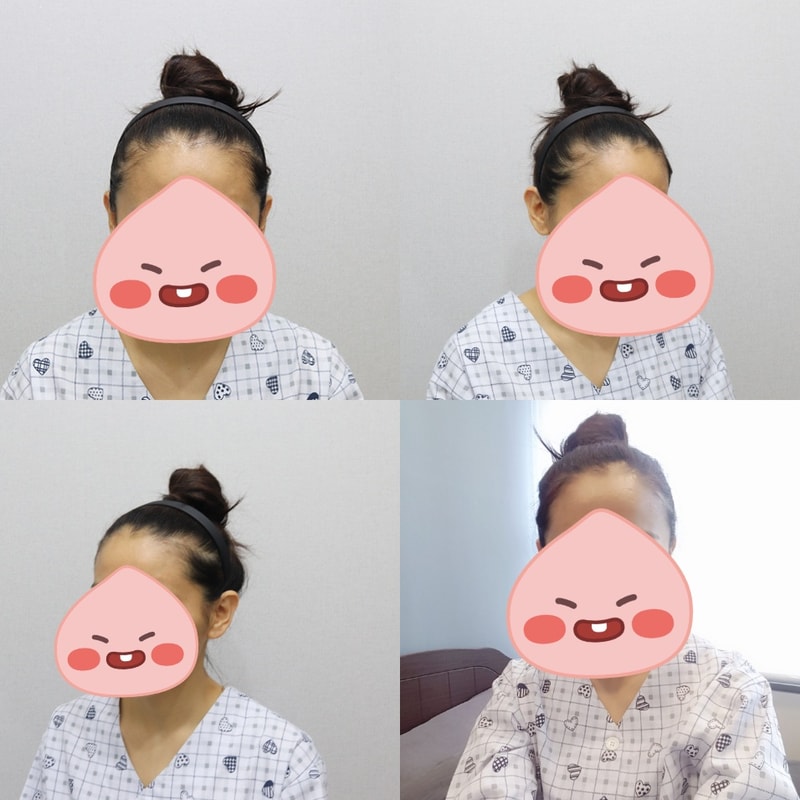 이식전.jpg