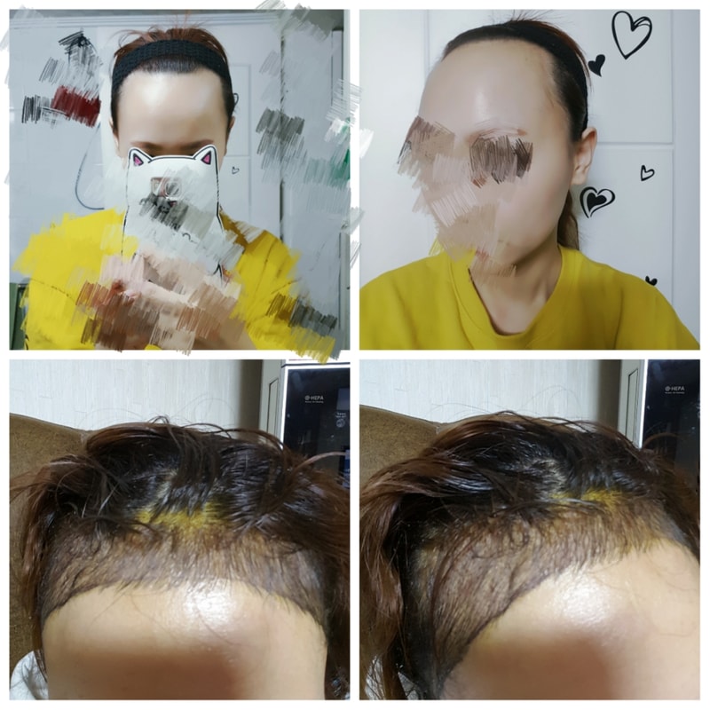 여자헤어라인4500모. 첫샴푸후