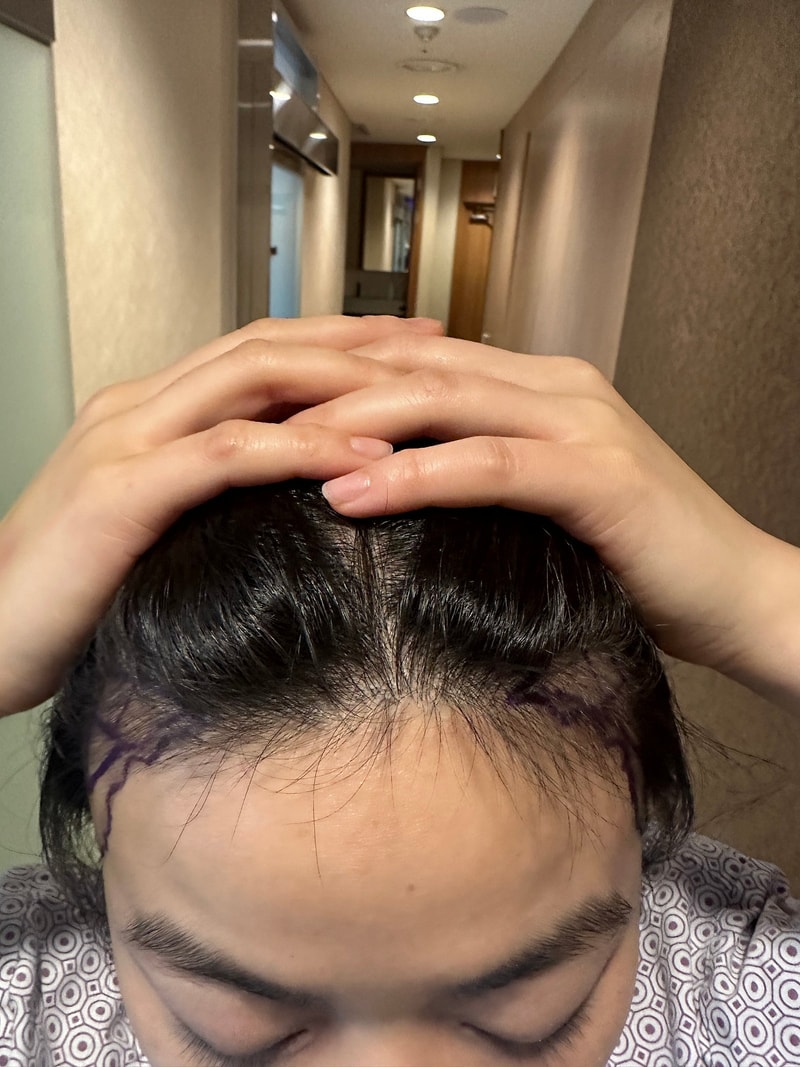 뉴헤어 헤어라인교정 1300모낭 9개월 후기