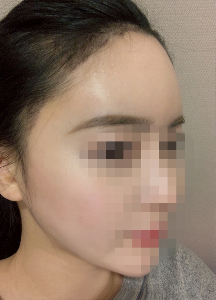 수술일주일04.jpg