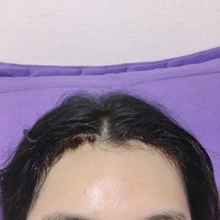 헤어라인 (3).jpg