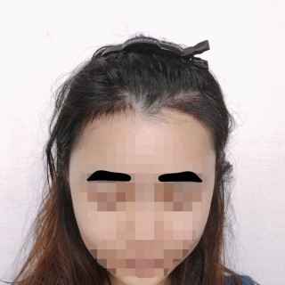헤어라인 (4).jpg