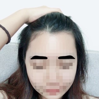 헤어라인 (2).jpg