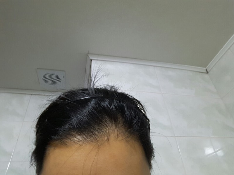 헤어라인 이식 10개월