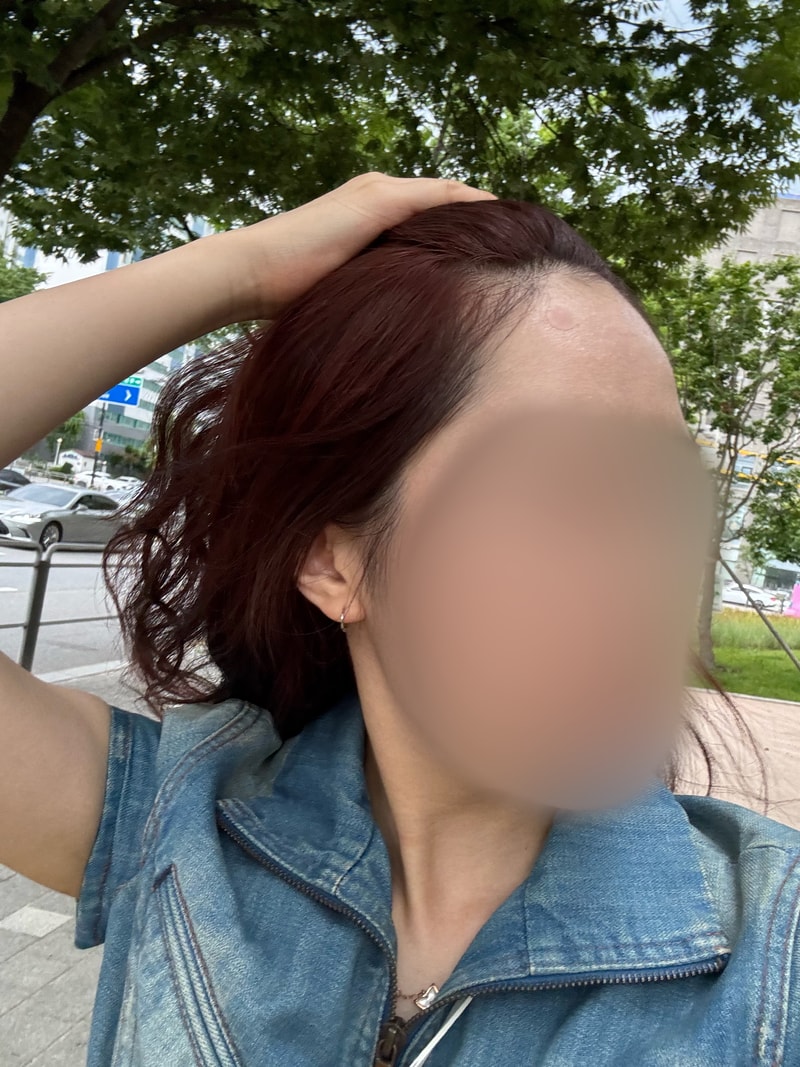 모발이식 1일차 후기입니다!