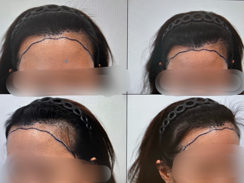 [MOEM Clinic] A review of the first year of 2700 hair incision Female Hairline correction.
