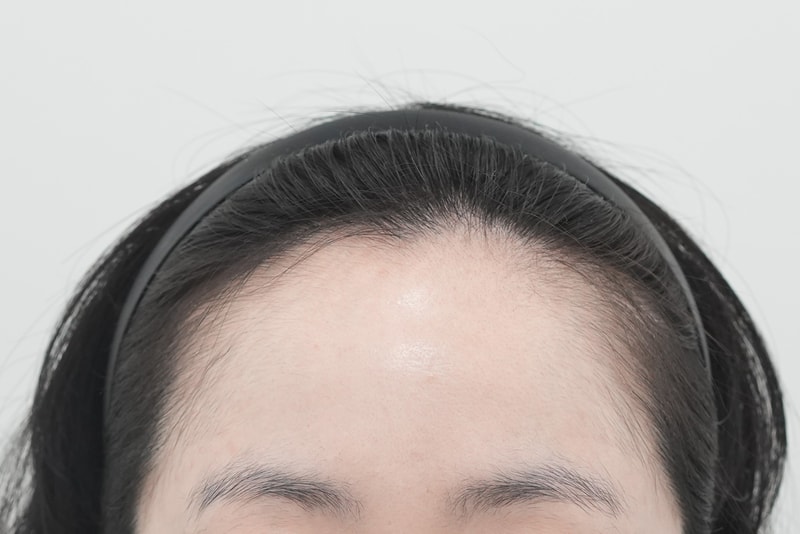 Changes in the hairline of Yonsei Moever Clinic's 3,000-mo late 7-month hairline