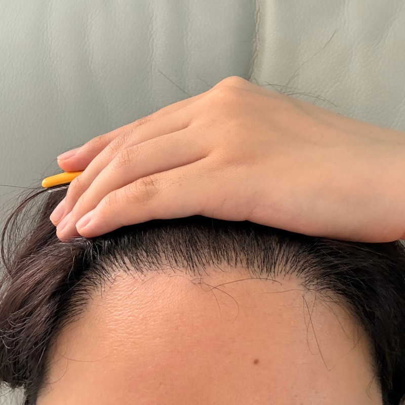 This is the review of non-cutaneous Hair Transplant in the 6th month of NEWHAiR at Gangnam Hair Transplantation Hospital.