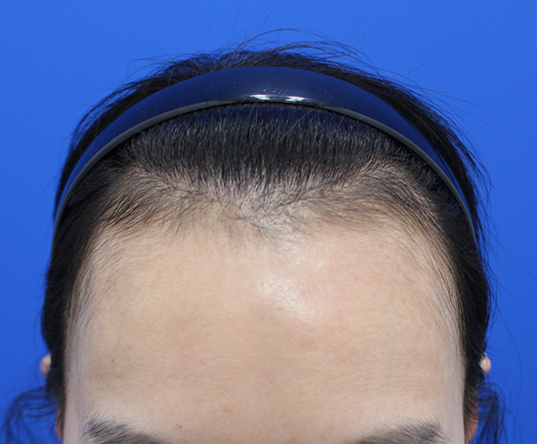 My parents gave it to me, but I'm trying to escape from my wide forehead ㅜㅜ(3100 mo surgery)