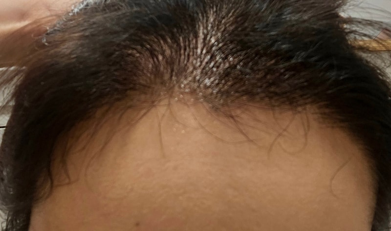 6th month review of NEWHAiRHair Transplant