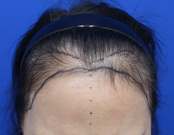 Hairline hair transplant post-mortem 2543 m