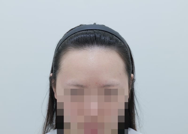 Yonsei Moever Clinic's 20s hairline Hair Transplant has recovered its self-esteem!!! (3,000 moles)