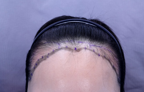 I got a hairline hair transplant in Yeonsemobel, Daegu!!