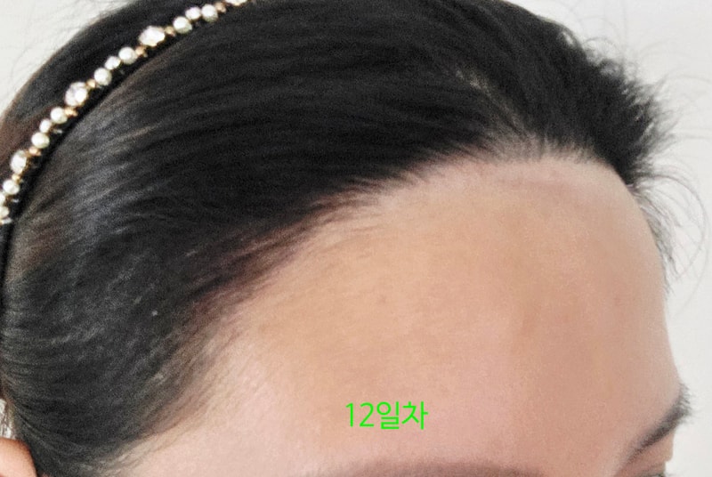 롱헤어 이식 750모낭 12일차  긴머리 심으니깐 티 1도 안남