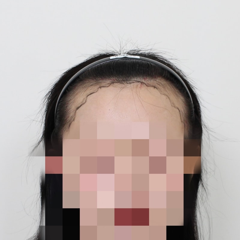 모프로의원 헤어라인 구렛나루 이식 4600모 11일차 후기
