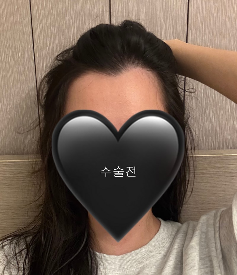 티 안 난다고 유명한 롱헤어 이식 솔직 후기