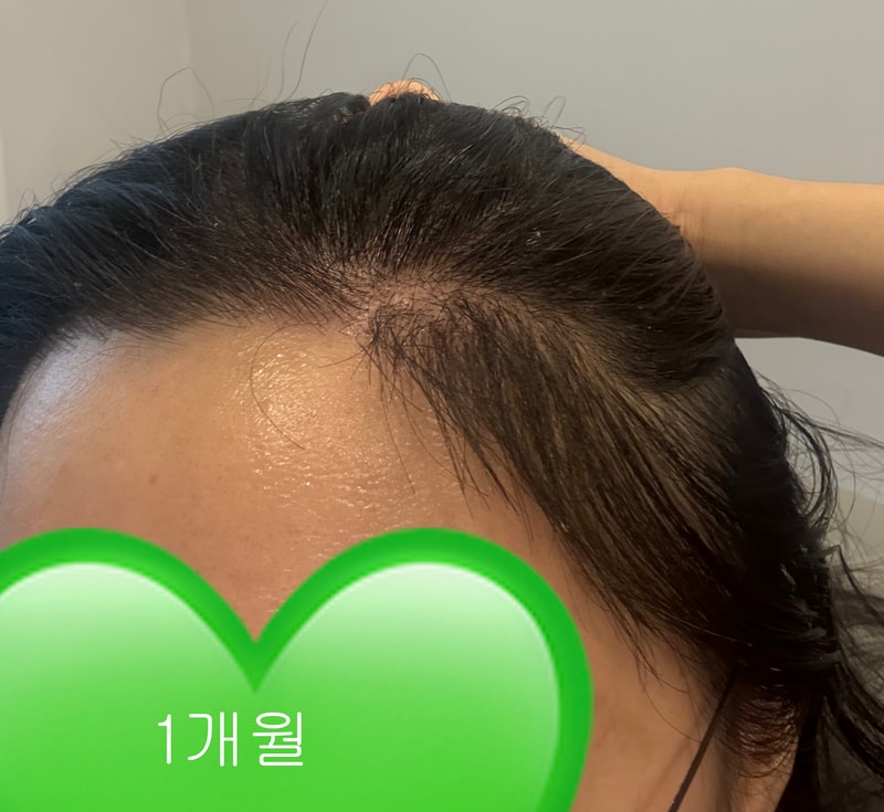 후기 없어서 내가 써보는 롱헤어이식 30일차 (feat.직장인 바로출근)