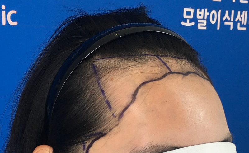헤어라인 모발이식 아주만족스러운 25일차 후기
