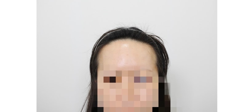 모프로의원  문건학원장님★ 헤어라인 3900모 6개월 차 경과 후기 