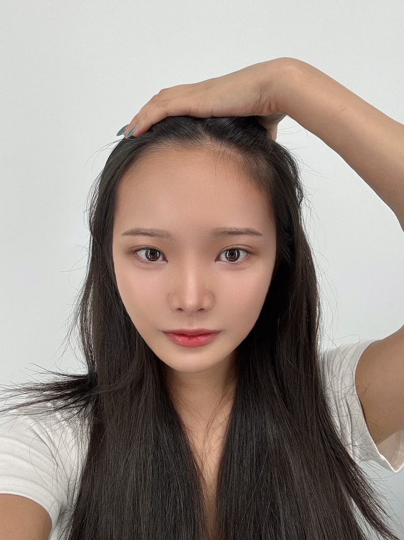 여자 헤어라인 교정 절개 2000모낭 두달차 후기